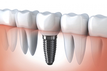 Implant Dentar